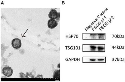 Higher Urine Exosomal miR-193a Is Associated With a Higher Probability of Primary Focal Segmental Glomerulosclerosis and an Increased Risk of Poor Prognosis Among Children With Nephrotic Syndrome